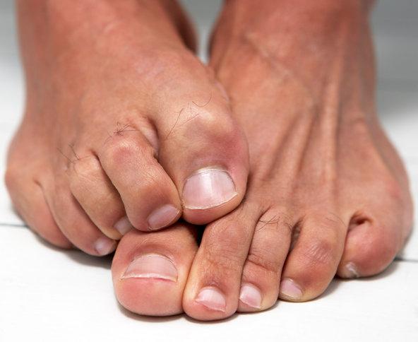En usund svamp på fødderne på fødderne: behandling med folkemæssige midler